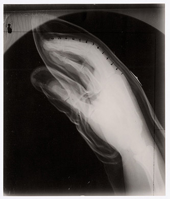 Anonyme, Radiographie d’une main. Tirage argentique, années 1950. © Musée Nicéphore Niépce.